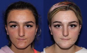 Female face, before and after rhinoplasty treatment, front view, patient 19