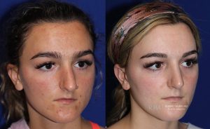  Female face, before and after rhinoplasty treatment, oblique view, patient 19