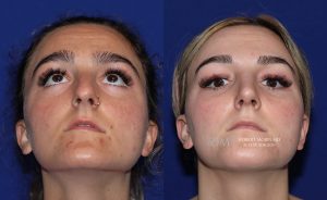  Female face, before and after rhinoplasty treatment, front view (thrown back) - patient 19