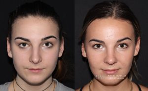  Female face, before and after rhinoplasty treatment, front view, patient 12