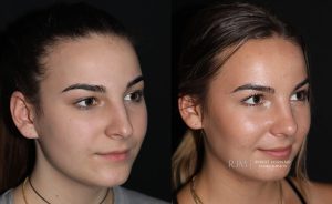  Female face, before and after rhinoplasty treatment, oblique view, patient 12