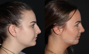  Female face, before and after rhinoplasty treatment, r-side view, patient 12