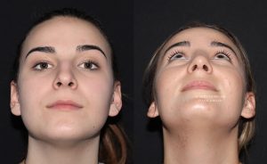  Female face, before and after rhinoplasty treatment, front view (thrown back) - patient 12