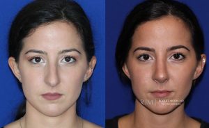  Female face, before and after rhinoplasty treatment, front view, patient 30