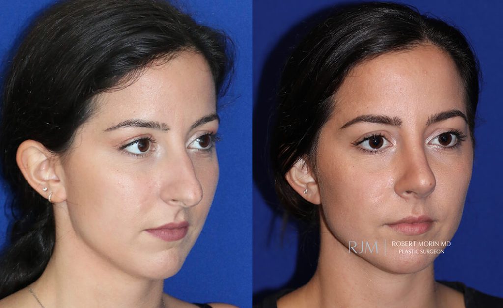  Female face, before and after rhinoplasty treatment in New Jersey, oblique view, patient 30