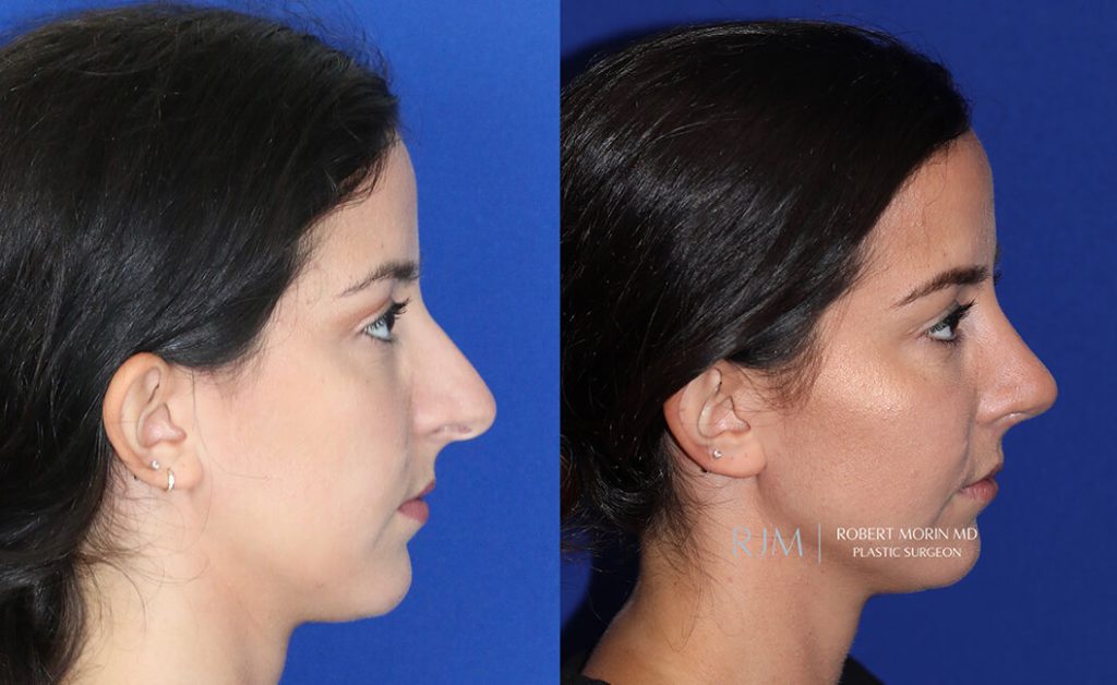  Female face, before and after rhinoplasty treatment in New Jersey, r-side view, patient 30