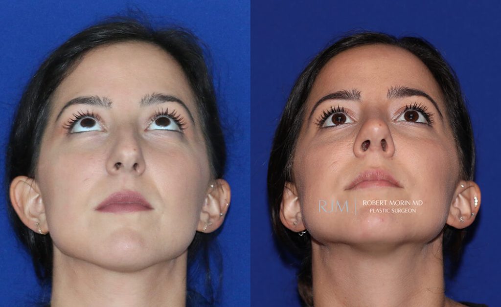  Female face, before and after rhinoplasty treatment in New Jersey, front view (thrown back) - patient 30