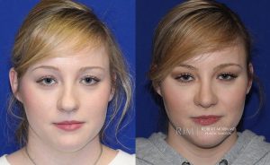  Female face, before and after rhinoplasty treatment, front view, patient 31