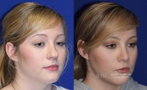  Female face, before and after rhinoplasty treatment, oblique view, patient 31