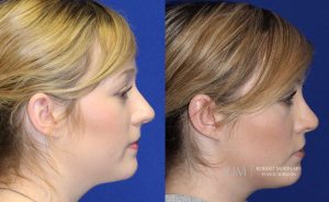  Female face, before and after rhinoplasty treatment, r-side view, patient 31