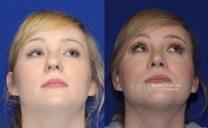  Female face, before and after rhinoplasty treatment, front view (thrown back) - patient 31