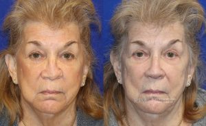  Woman's face, before and after rhinoplasty treatment, front view, patient 32