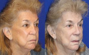  Woman's face, before and after rhinoplasty treatment, oblique view, patient 32