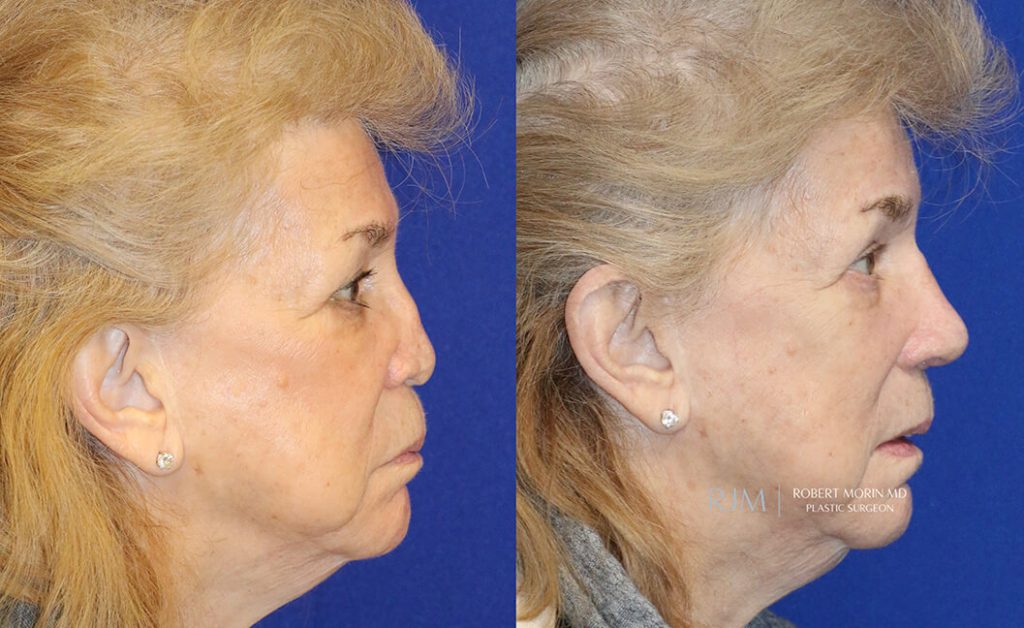  Woman's face, before and after rhinoplasty treatment in New Jersey, r-side view, patient 32