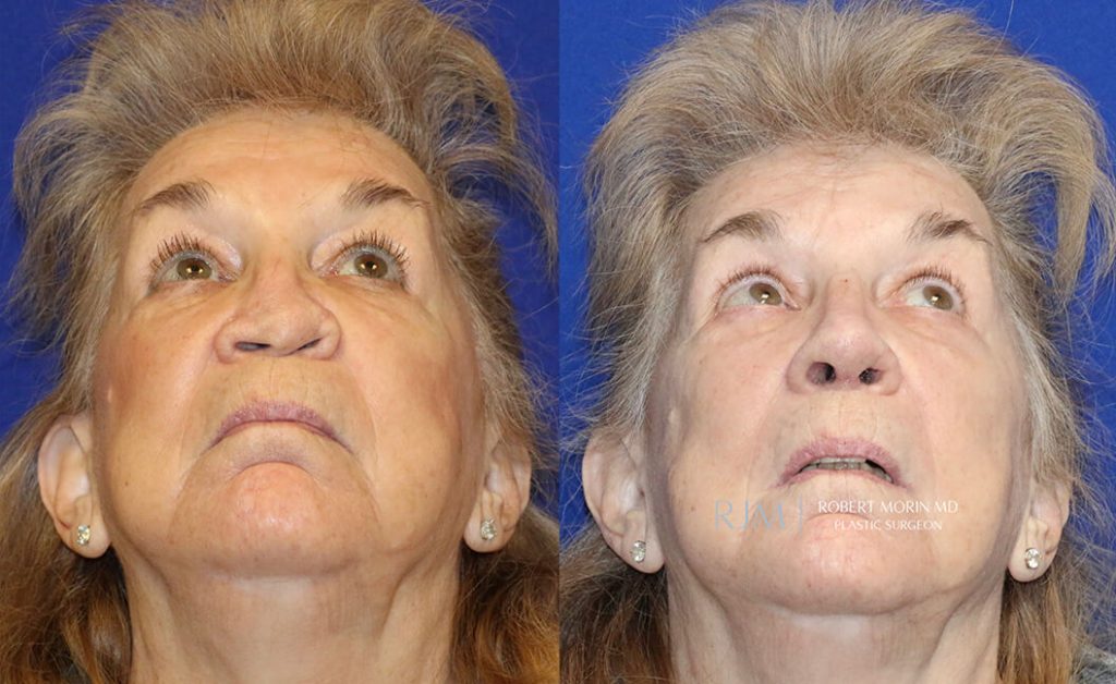  Woman's face, before and after rhinoplasty treatment in New Jersey, front view (thrown back) - patient 32