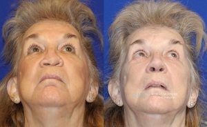  Woman's face, before and after rhinoplasty treatment, front view (thrown back) - patient 32