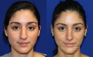  Female face, before and after rhinoplasty treatment, front view, patient 15