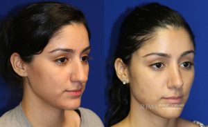  Female face, before and after rhinoplasty treatment, oblique view, patient 15