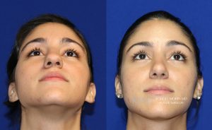  Female face, before and after rhinoplasty treatment, front view (thrown back) - patient 15