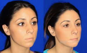  Female face, before and after rhinoplasty treatment, oblique view, patient 33