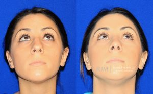  Female face, before and after rhinoplasty treatment, front view (thrown back) - patient 33