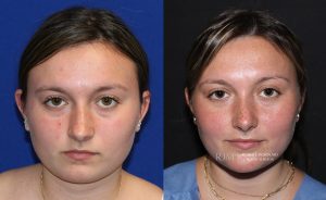  Female face, before and after rhinoplasty treatment, front view, patient 34
