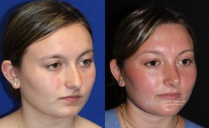  Female face, before and after rhinoplasty treatment, oblique view, patient 34