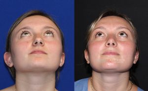  Female face, before and after rhinoplasty treatment, front view (thrown back) - patient 34