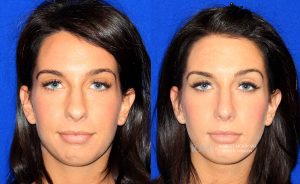  Female face, before and after rhinoplasty treatment, front view, patient 20