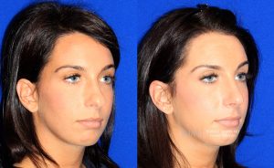  Female face, before and after rhinoplasty treatment, oblique view, patient 20