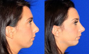  Female face, before and after rhinoplasty treatment, r-side view, patient 20