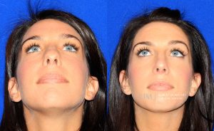  Female face, before and after rhinoplasty treatment, front view (thrown back) - patient 20