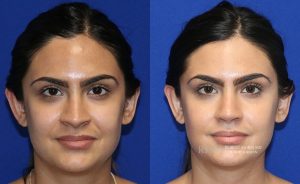  Female face, before and after rhinoplasty treatment, front view, patient 35