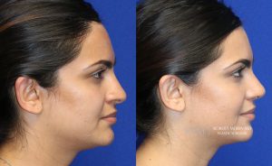  Female face, before and after rhinoplasty treatment, r-side view, patient 35