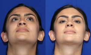  Female face, before and after rhinoplasty treatment, front view (thrown back) - patient 35
