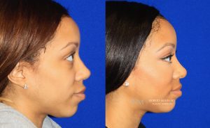  Female face, before and after rhinoplasty treatment, r-side view, patient 36