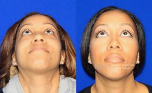  Female face, before and after rhinoplasty treatment, front view (thrown back) - patient 36