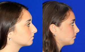  Female face, before and after rhinoplasty treatment, r-side view, patient 22
