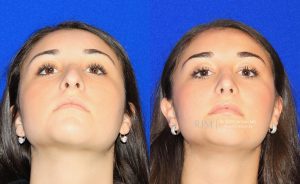  Female face, before and after rhinoplasty treatment, front view (thrown back) - patient 22