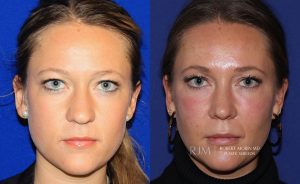  Female face, before and after rhinoplasty treatment, front view, patient 37
