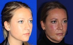  Female face, before and after rhinoplasty treatment, oblique view, patient 37
