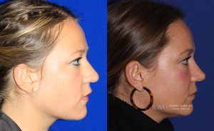  Female face, before and after rhinoplasty treatment, r-side view, patient 37