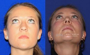  Female face, before and after rhinoplasty treatment, front view (thrown back) - patient 37