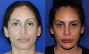  Female face, before and after rhinoplasty treatment in New Jersey, front view, patient 38