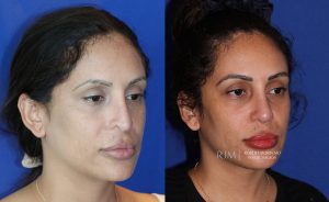  Female face, before and after rhinoplasty treatment in New Jersey, oblique view, patient 38