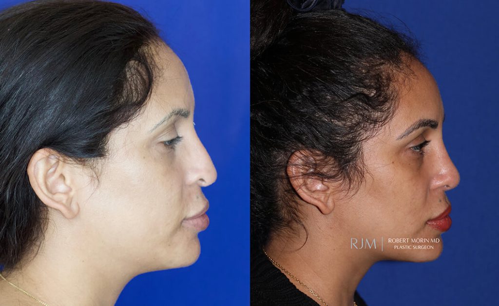  Female face, before and after rhinoplasty treatment in New Jersey, r-side view, patient 38
