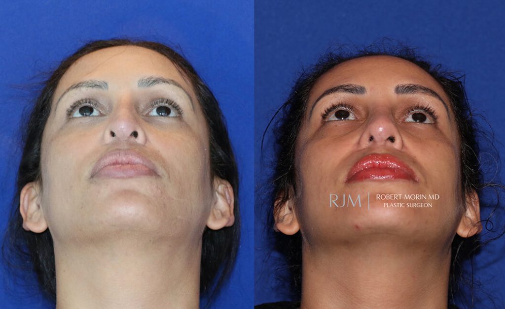  Female face, before and after rhinoplasty treatment in New Jersey, front view (thrown back) - patient 38