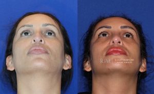  Female face, before and after rhinoplasty treatment, front view (thrown back) - patient 38