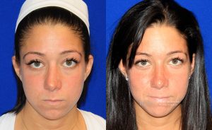  Female face, before and after rhinoplasty treatment, front view, patient 39