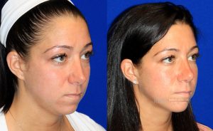  Female face, before and after rhinoplasty treatment, oblique view, patient 39